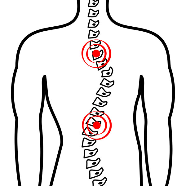 Should You Be Worried About Heavy School Bags & Scoliosis?