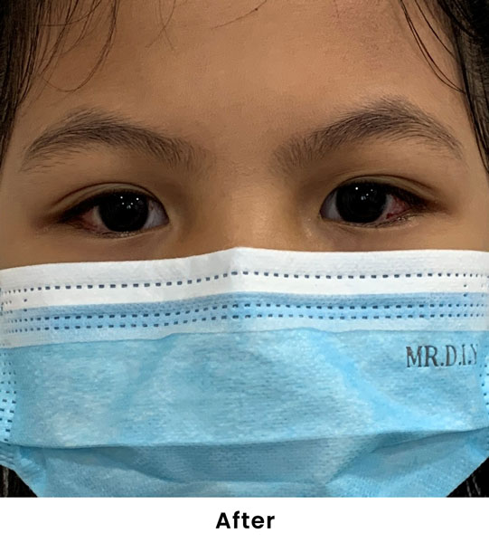 Squint Treatment for Children: A Life-Changing Experience